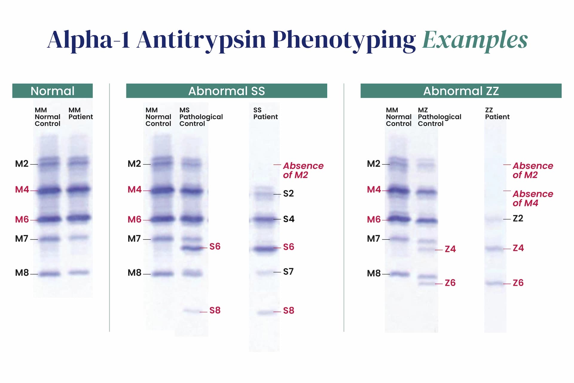 Examples of A1AT Phenotyping