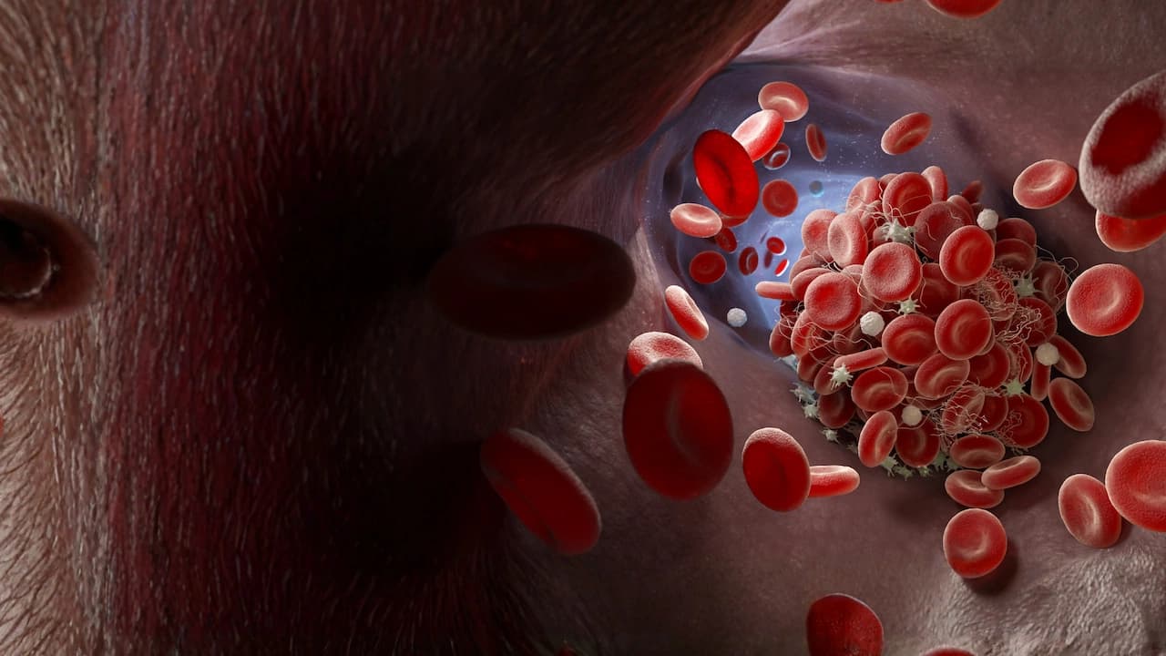 Formation of a blood clot