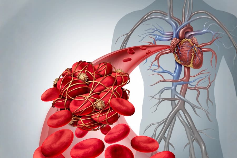 Human body highlighting blood Clot Risk