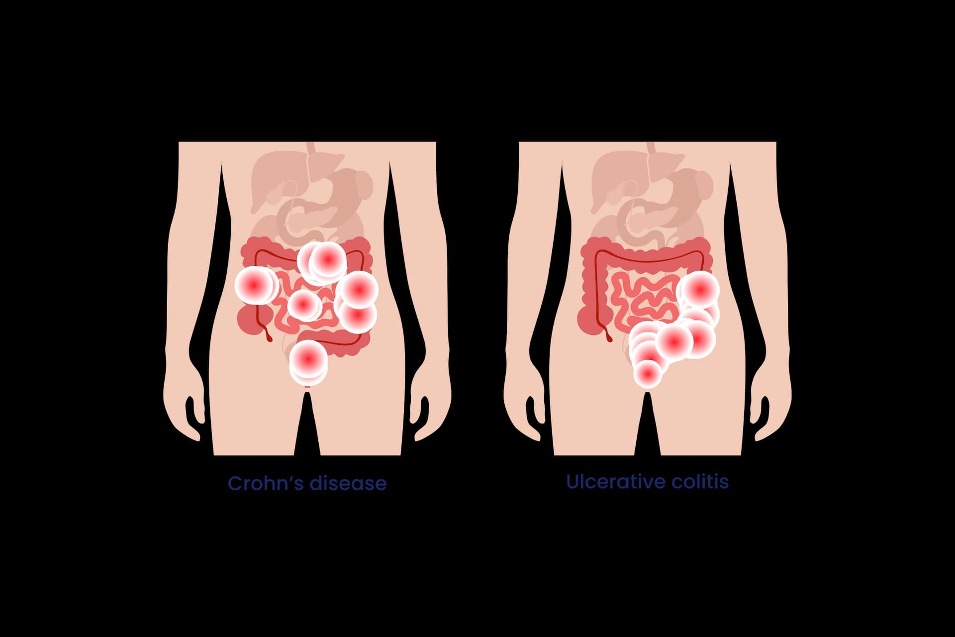 Example of type of Inflammatory Bowel Diseases, Crohn's disease and Ulcerative colitis