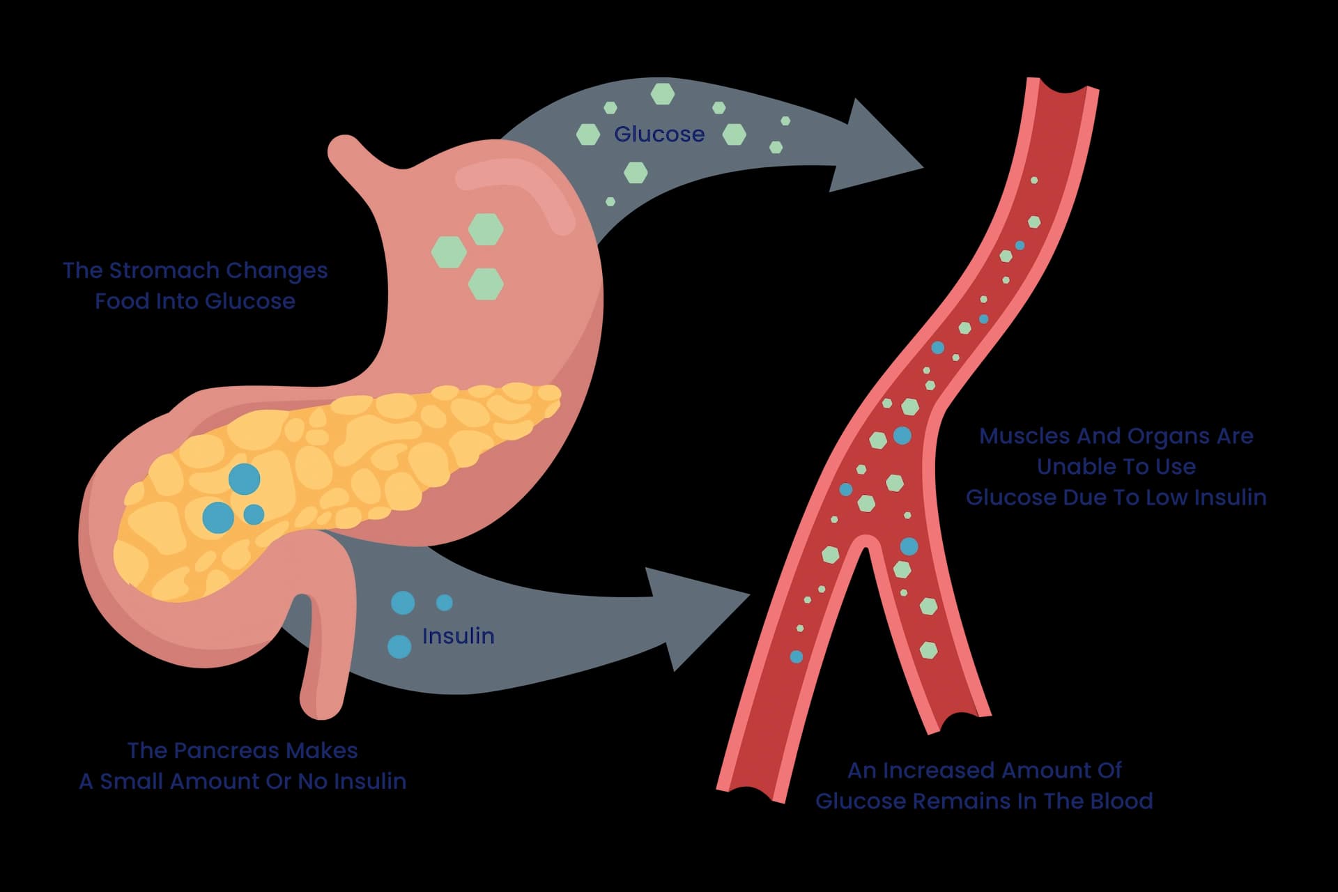 Explanation of Type 1 Diabetes