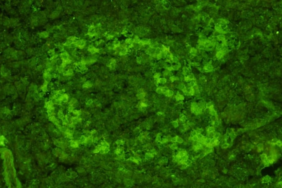 Sebia Islet Cell Antibody pattern